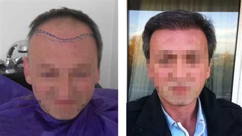 hermest hair transplant cost.